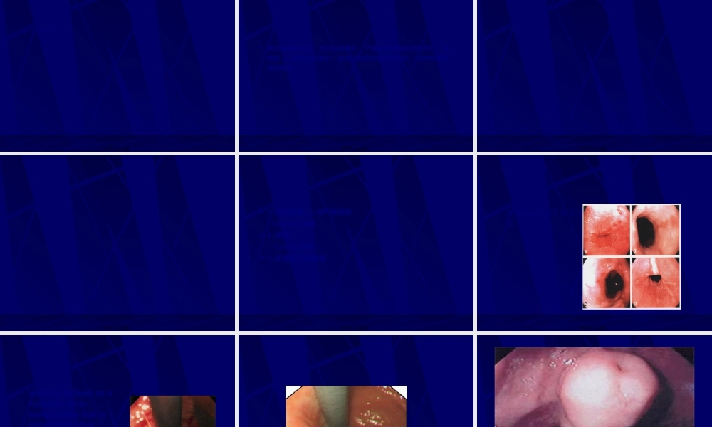 2022年医学专题—消化道出血-----呕血(1).ppt