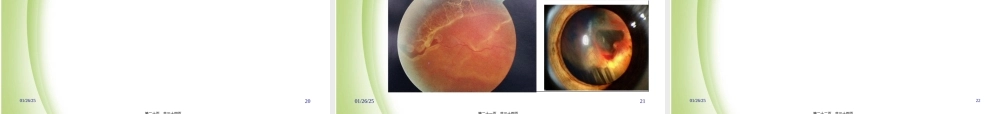 2022年医学专题—眼底病部分(1).ppt