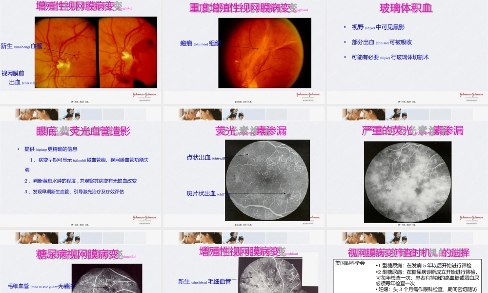 2022年医学专题—糖尿病慢性并发症---微血管病变(1).pptx