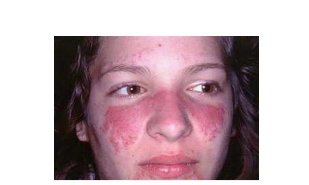 2022年医学专题—系统性红斑狼疮-药学监护(1).ppt