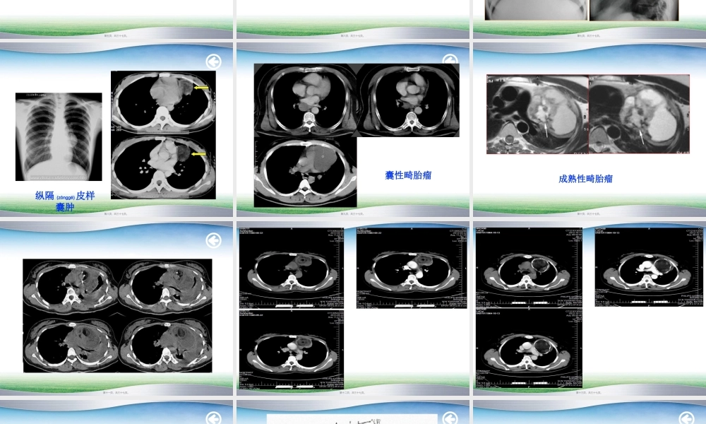 2022年医学专题—纵膈畸胎瘤(1).ppt
