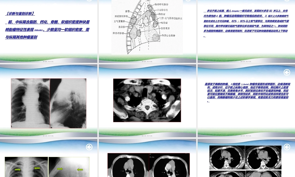 2022年医学专题—纵膈畸胎瘤(1).ppt