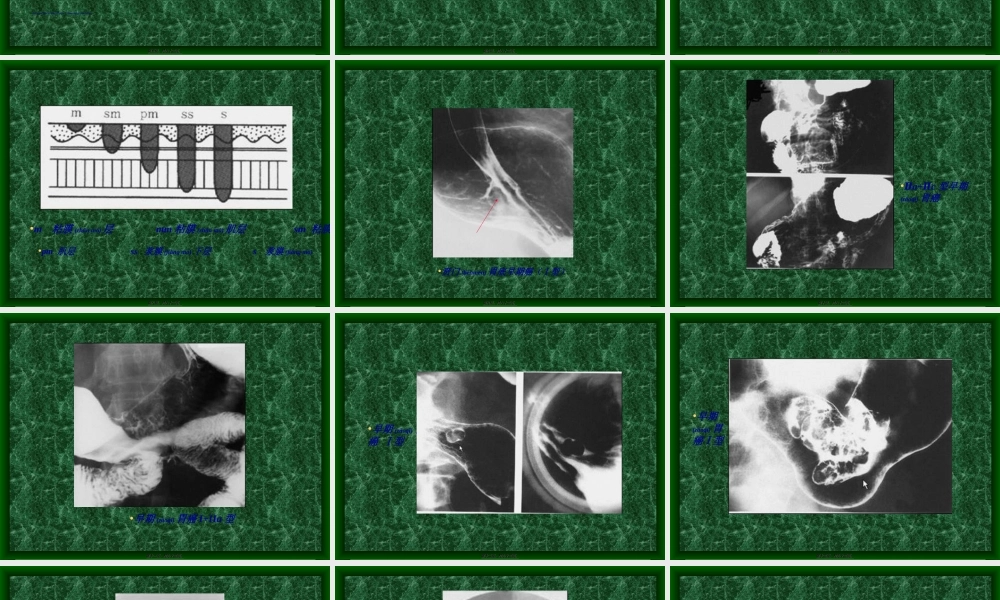 2022年医学专题—胃癌及胃其它占美位病变(1).ppt