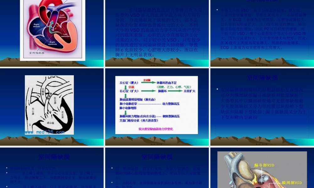 先心病(室间隔缺损)(1).pptx