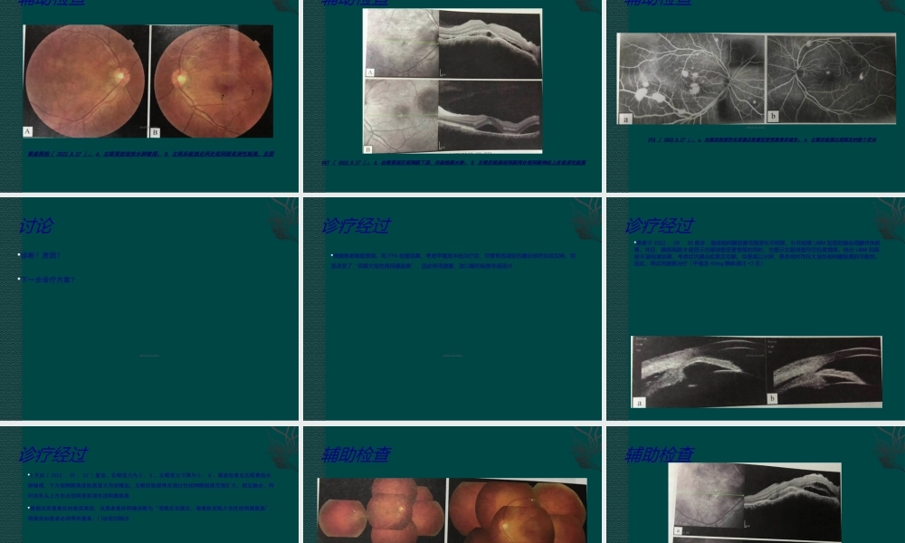 大泡性视网膜脱离疑难病例讨论(1).ppt