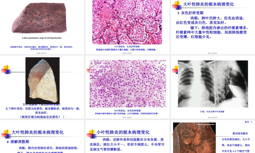 实习10-慢支炎、肺气肿、肺心病、肺炎(1).pptx