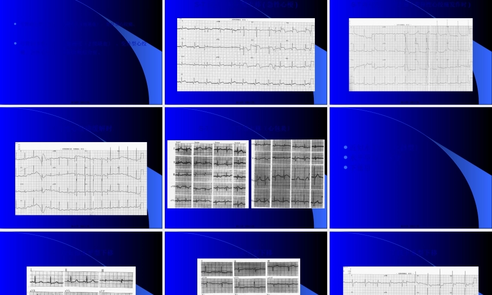 冠心病心电图(1).pptx