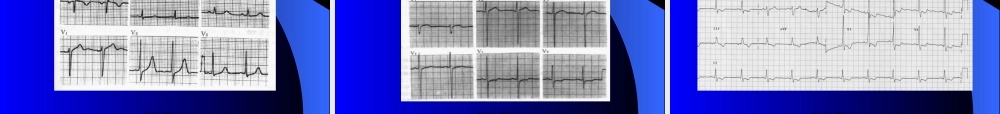 冠心病心电图(1).pptx