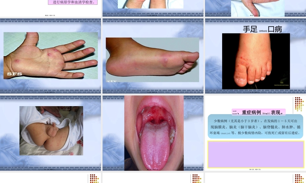 2022年医学专题—手足口病诊疗技术(1).ppt