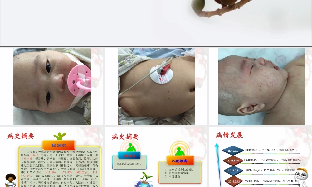 血小板减少性紫癜查房(1).ppt