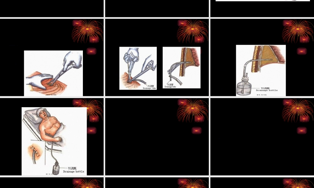 2022年医学专题—胸腔闭式引流术及注意事项-ppt..(1).ppt