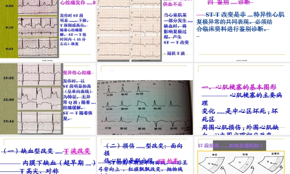 2022年医学专题—心肌缺血、梗塞(1).ppt