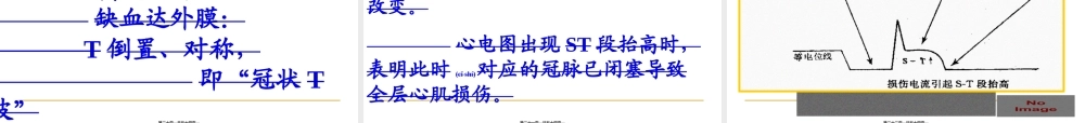 2022年医学专题—心肌缺血、梗塞(1).ppt