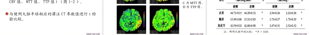 急性缺血性脑卒中灌注CT成像应用研究-柯开富(1).ppt