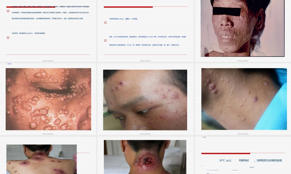 2022年医学专题—AIDS合并马尔尼菲青霉菌病李勇(1).ppt