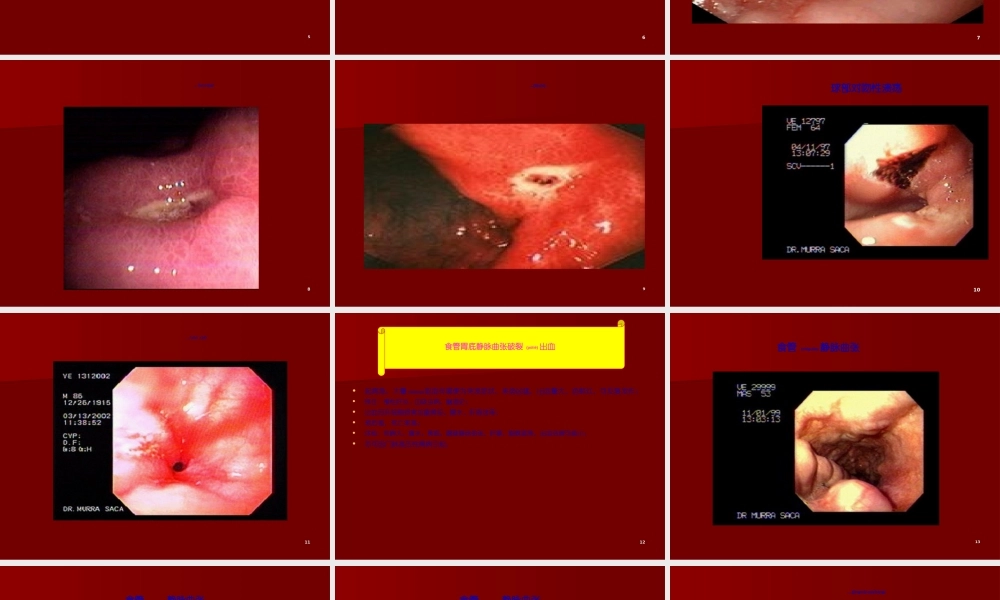 2022年医学专题—上消化道出血33(1).ppt