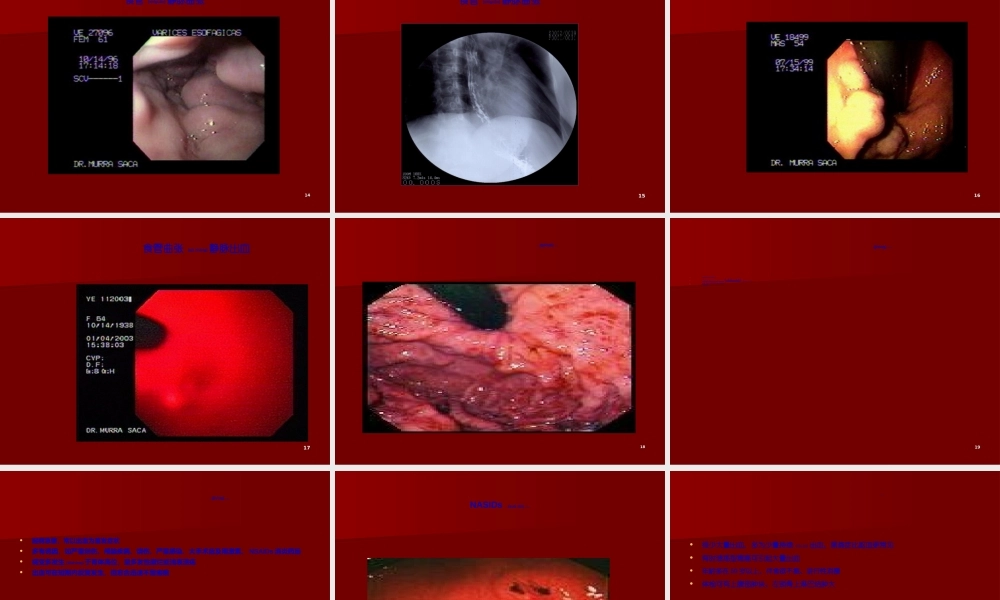 2022年医学专题—上消化道出血33(1).ppt