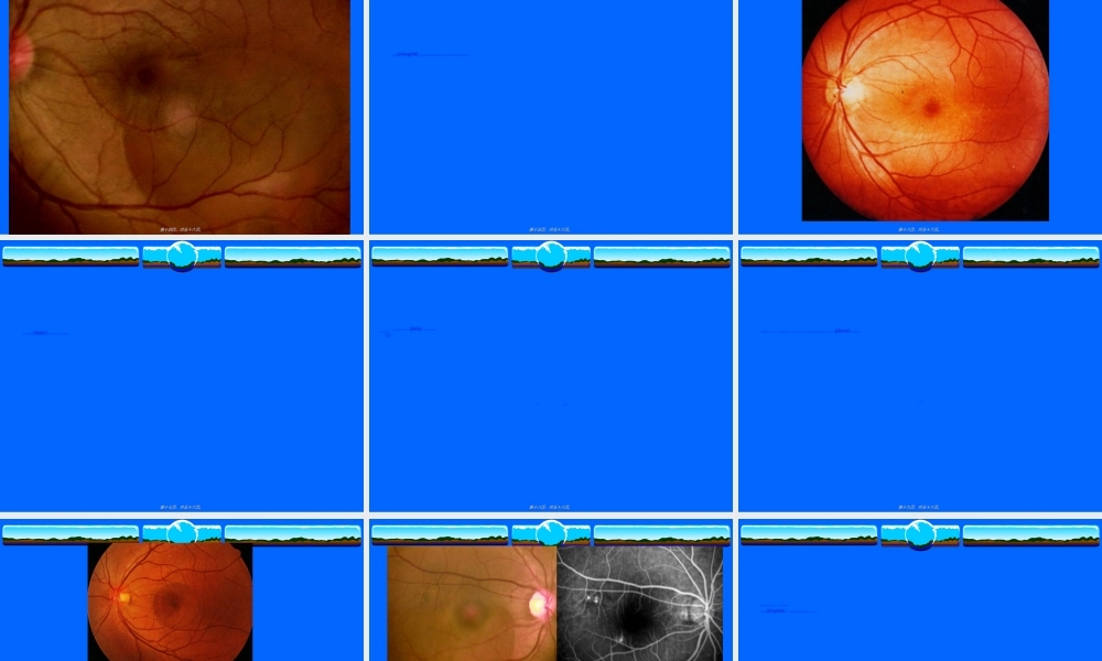 2022年医学专题—中心性浆液性脉络膜视网膜病变(1).ppt