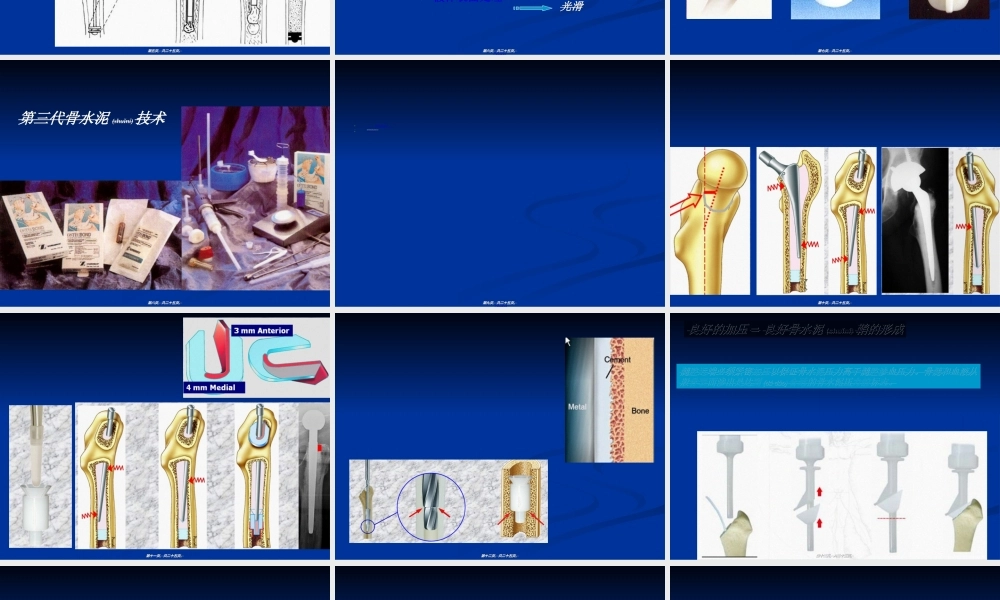2022年医学专题—人工髋置换的骨水泥技术(1).ppt