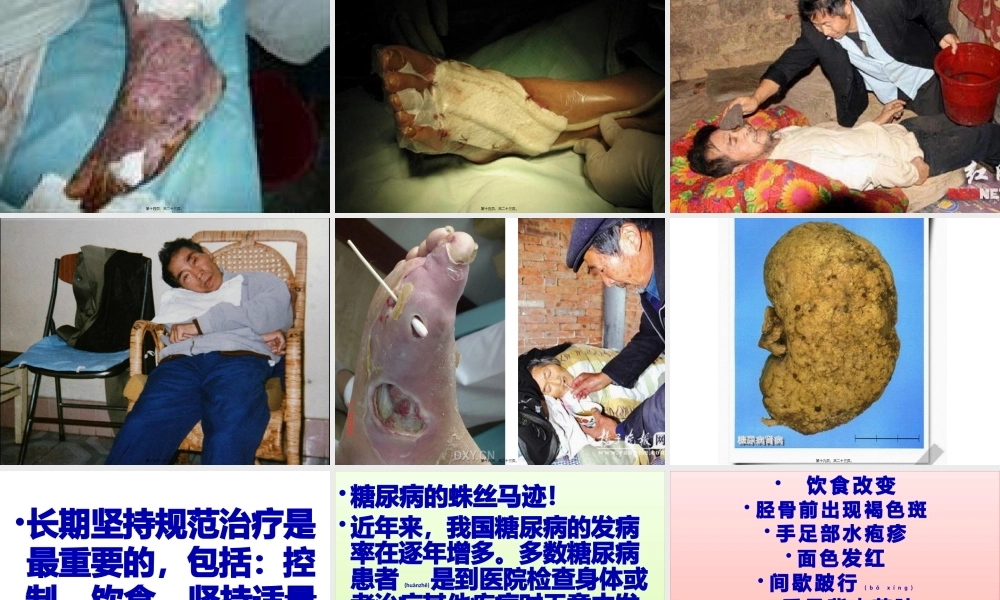 2022年医学专题—人类健康的杀手糖尿病(1).pptx