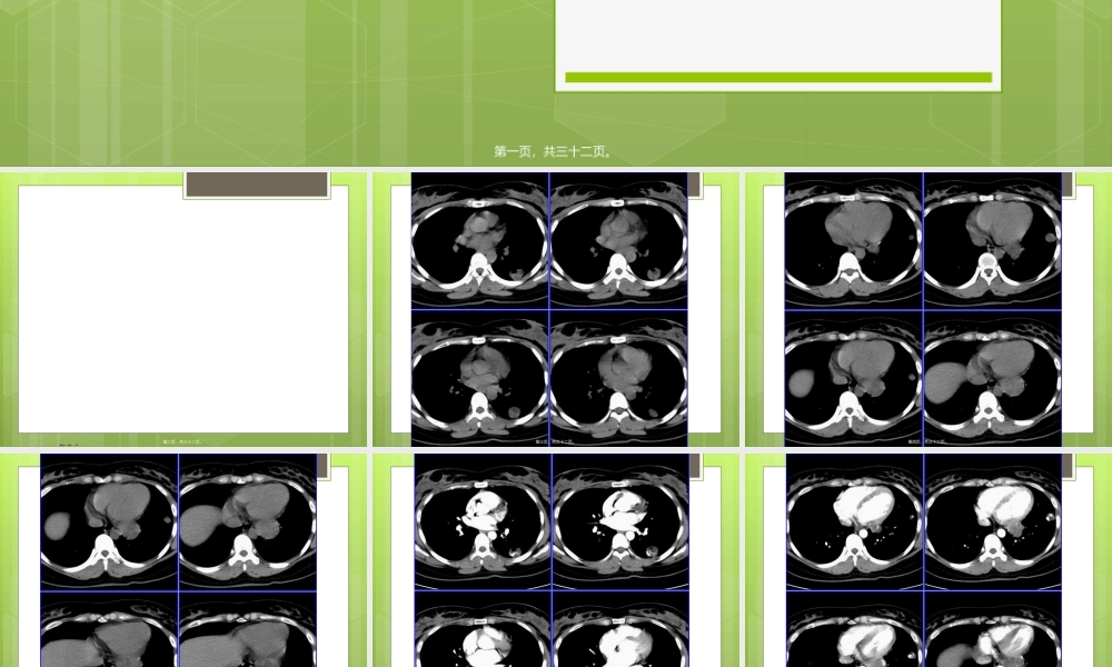 2022年医学专题—侵袭性葡萄胎肺转移(1).ppt