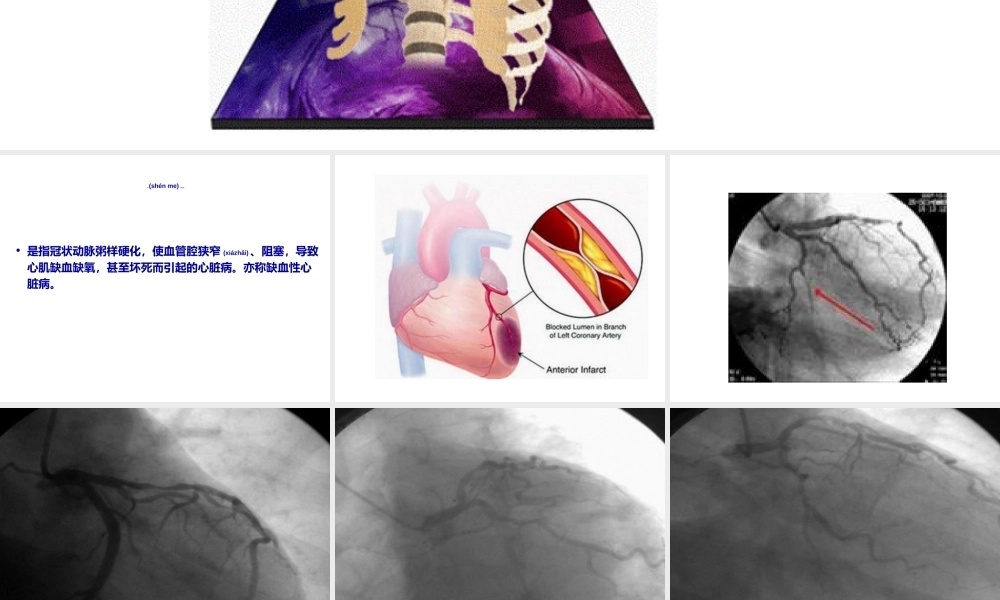 2022年医学专题—冠状动脉介入(1).ppt