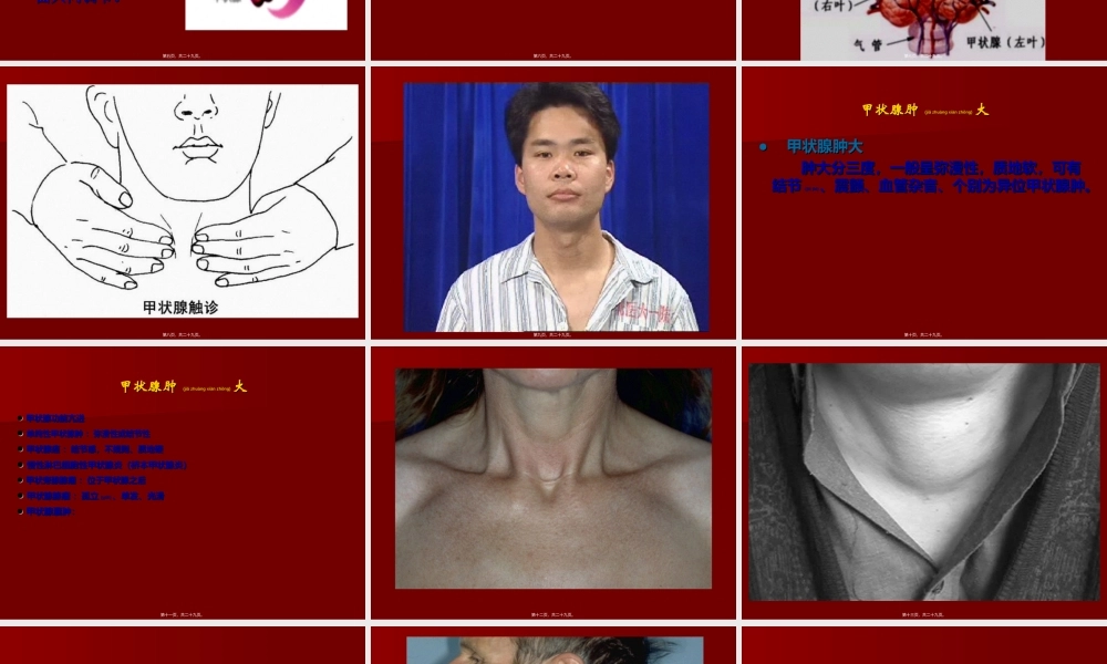 2022年医学专题—单纯性甲状腺肿PPT(1).ppt