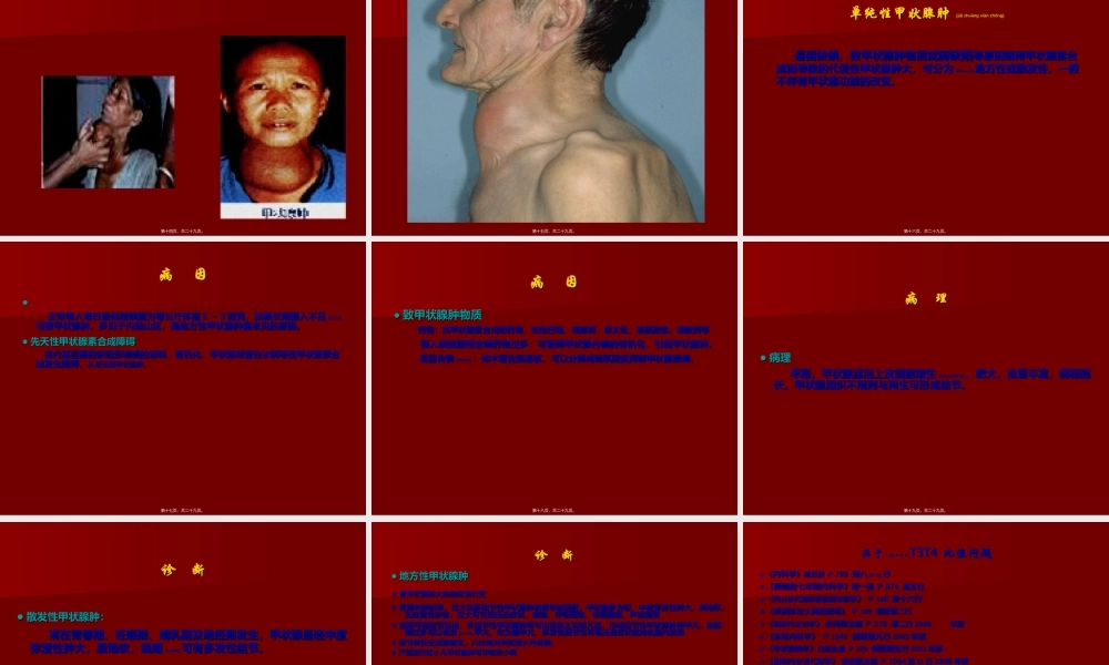 2022年医学专题—单纯性甲状腺肿PPT(1).ppt