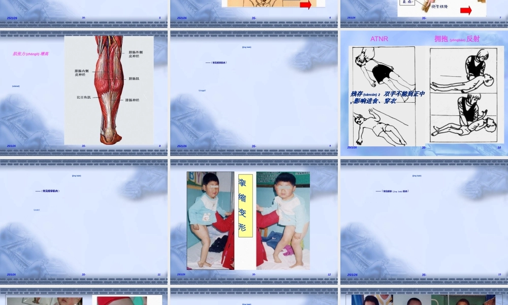 2022年医学专题—小儿脑瘫痉挛型的康复训练(1).ppt