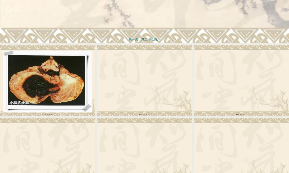 2022年医学专题—小脑出血(1).ppt