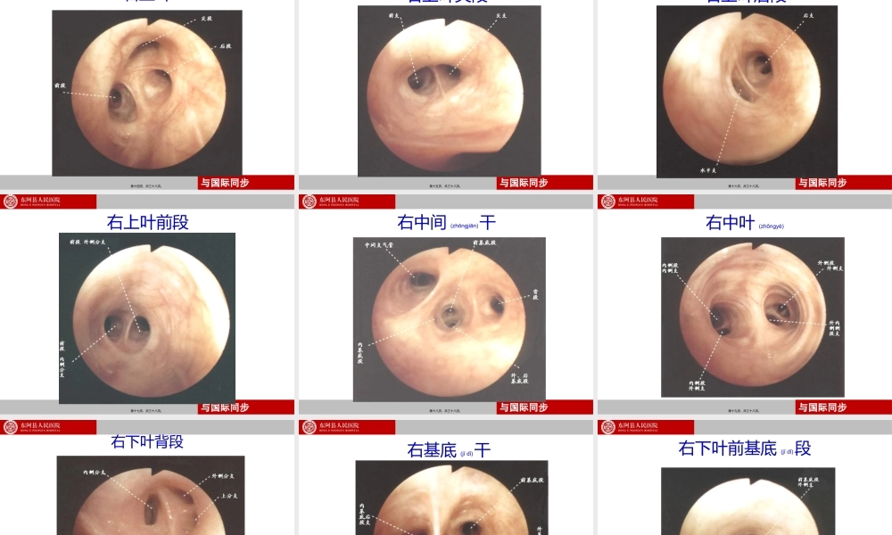 2022年医学专题—支气管镜下肺脏的分段(1).ppt