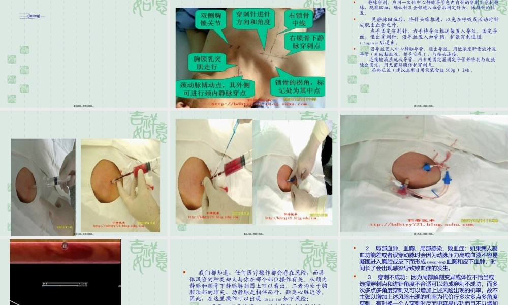 2022年医学专题—新建-锁骨下静脉穿刺(1).ppt