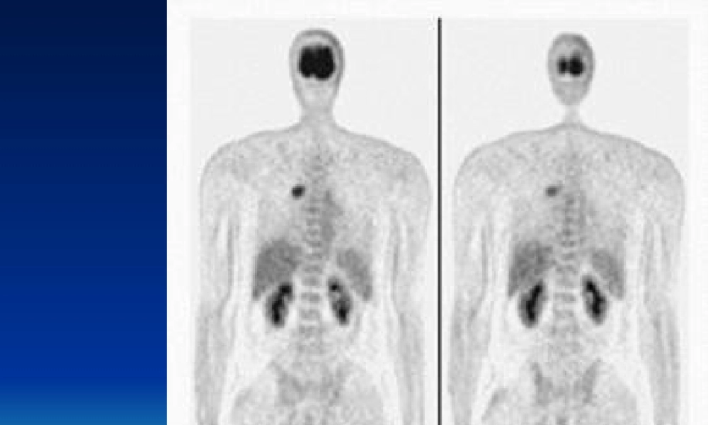 2022年医学专题—最新PET病例-PPT文档(1).ppt