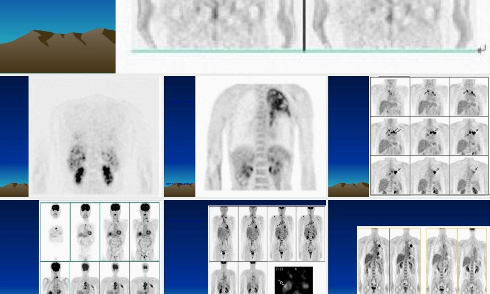 2022年医学专题—最新PET病例-PPT文档(1).ppt