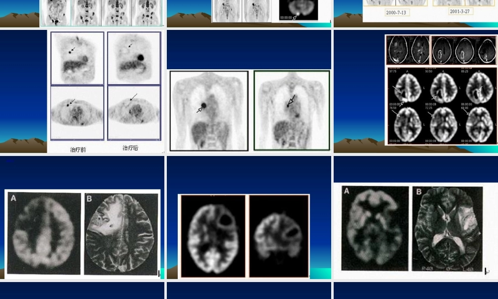 2022年医学专题—最新PET病例-PPT文档(1).ppt