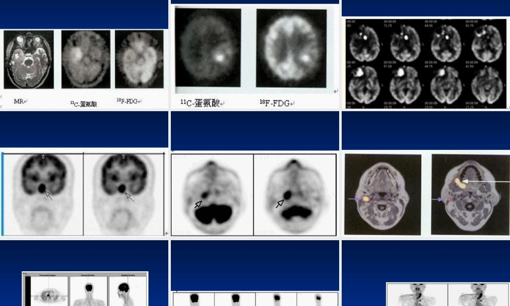2022年医学专题—最新PET病例-PPT文档(1).ppt