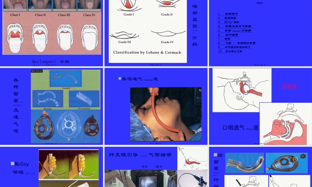 2022年医学专题—气管插管及困难气道的处理(1).ppt