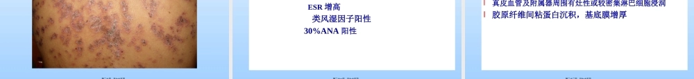 2022年医学专题—皮肤性病学——红斑狼疮(1).ppt
