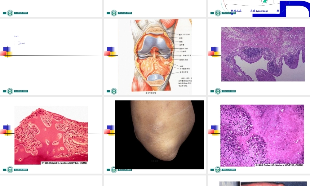 2022年医学专题—类风湿关节炎幻灯(1).ppt
