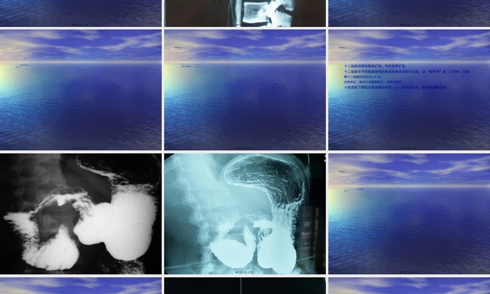 2022年医学专题—肠系膜上动脉综合征(1).ppt