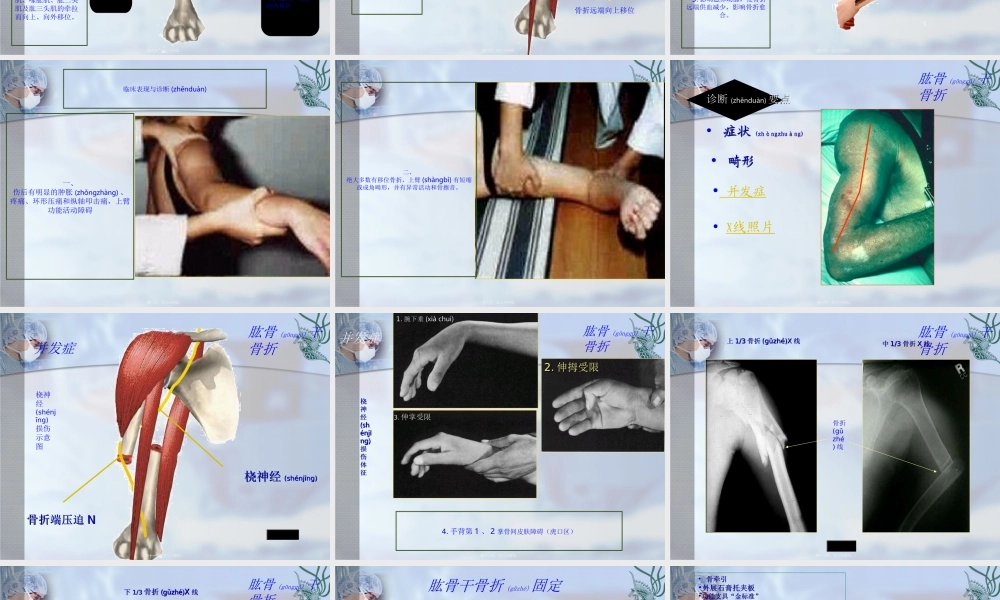 2022年医学专题—肱骨干骨折(1).ppt
