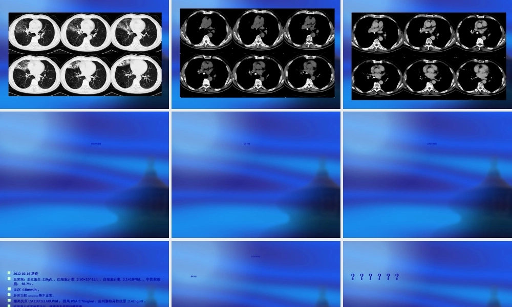 2022年医学专题—肺炎？支气管结石(1).ppt