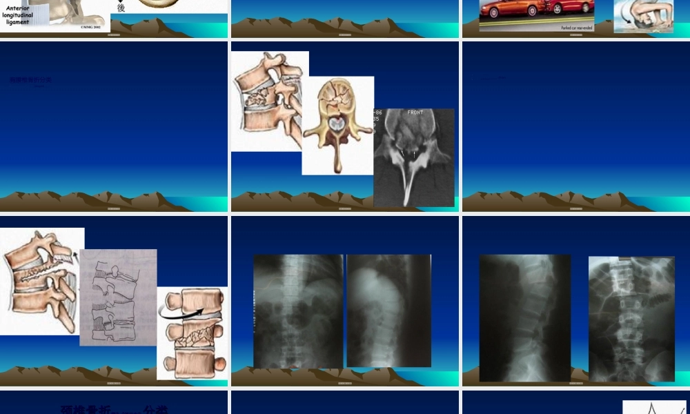 2022年医学专题—脊柱和骨盆骨折--正式版(1).ppt