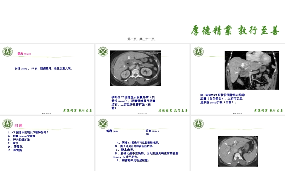 2022年医学专题—Mirizzi综合症(米利兹综合征)(肝管狭窄综合症).pptx