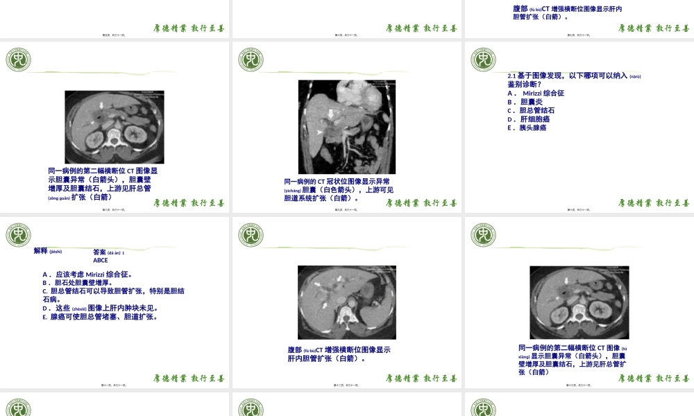 2022年医学专题—Mirizzi综合症(米利兹综合征)(肝管狭窄综合症).pptx