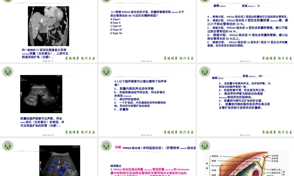 2022年医学专题—Mirizzi综合症(米利兹综合征)(肝管狭窄综合症).pptx