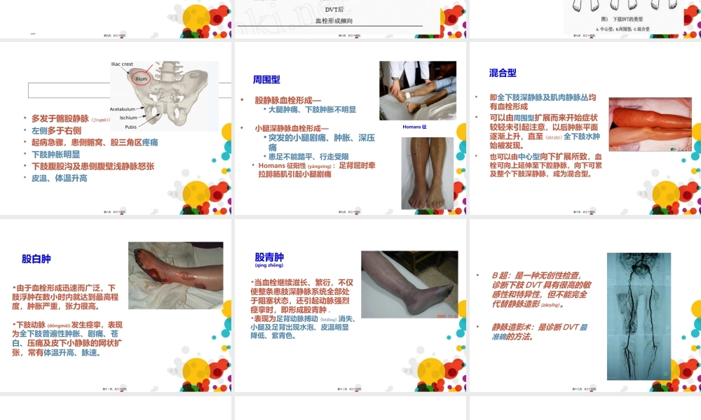 2022年医学专题—下肢深静脉血栓(成稿).ppt