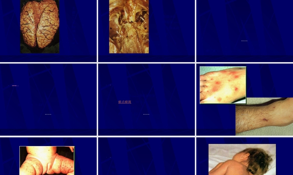 2022年医学专题—临-流行性脑脊髓膜炎.ppt