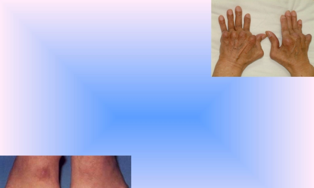 2022年医学专题—中西结合7年制教材(大量图片)类风湿性关节炎.ppt