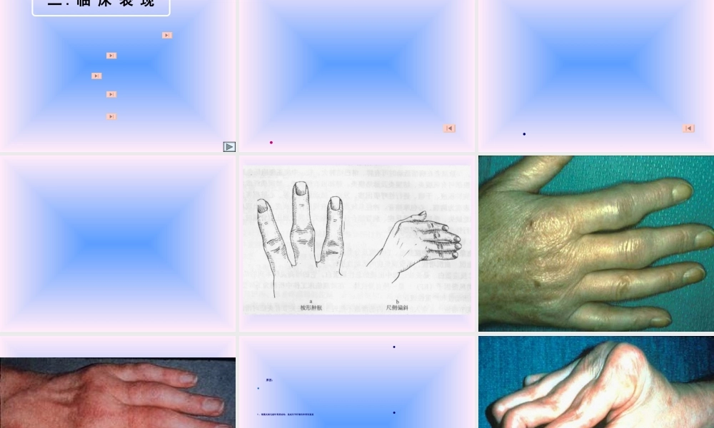 2022年医学专题—中西结合7年制教材(大量图片)类风湿性关节炎.ppt